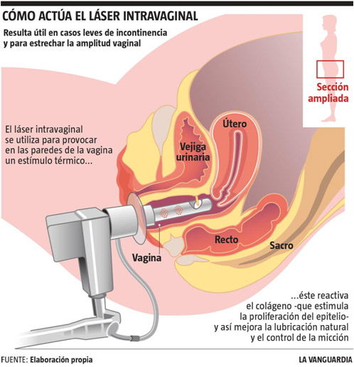 Laser intravaginal Fuente_ la Vanguardia
