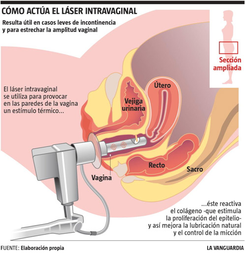 LaVanguardia - laser intravaginal