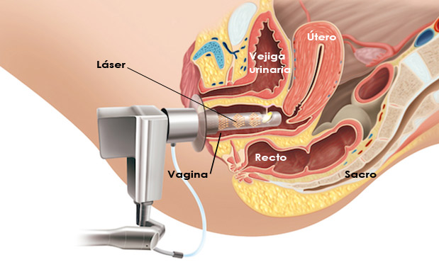 Laser-vaginal