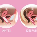 Amplitud vaginal: ¿qué es y cómo se soluciona? Amplitud vaginal: ¿qué es y cómo se soluciona?