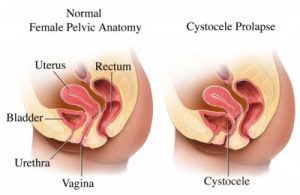 cistocele