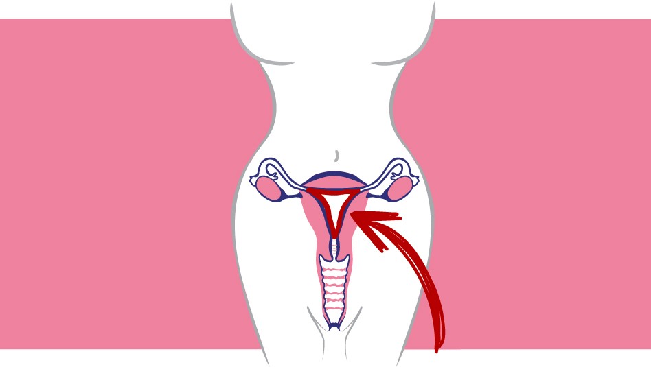 img-endometriosis