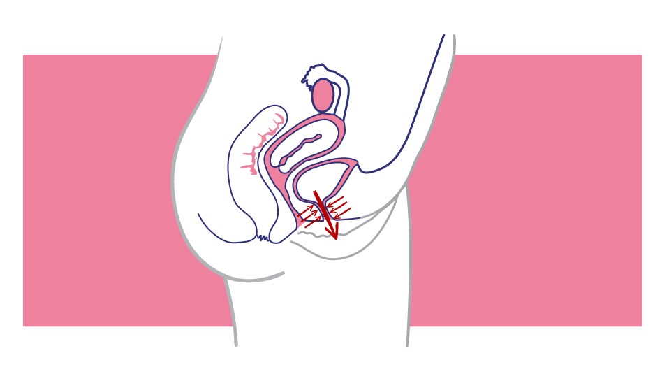 Pérdidas de orina o incontinencia urinaria en mujeres
