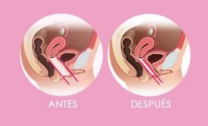 Antes y después de la amplitud vaginal tratada con láser ginecológico
