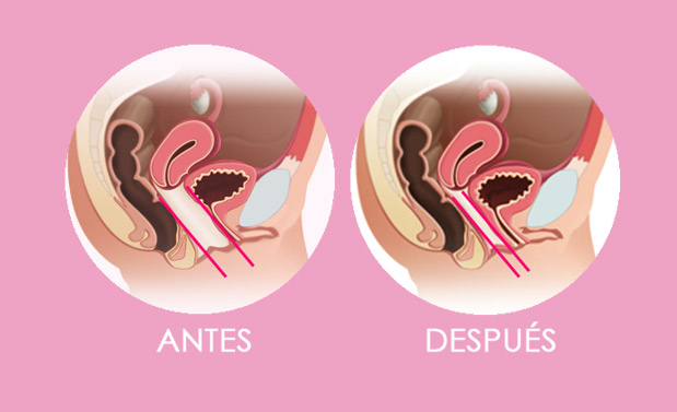 img-amplitud-vaginal-antes-y-despues-del-laser