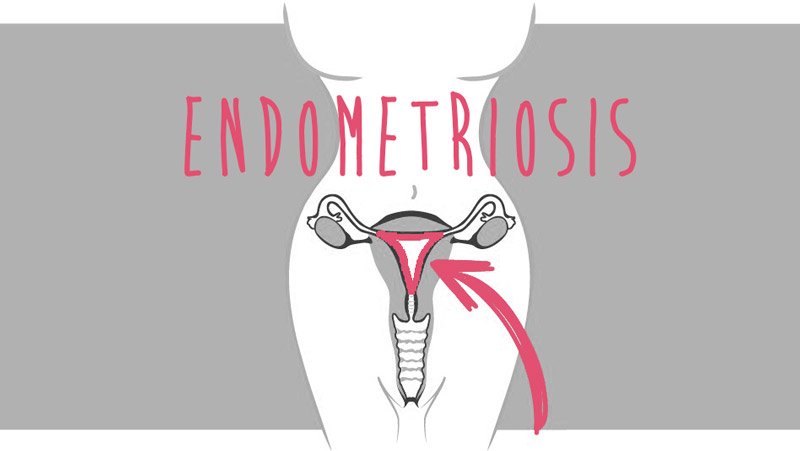 endometriosis