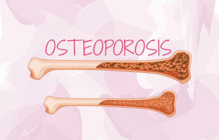 osteoporosis