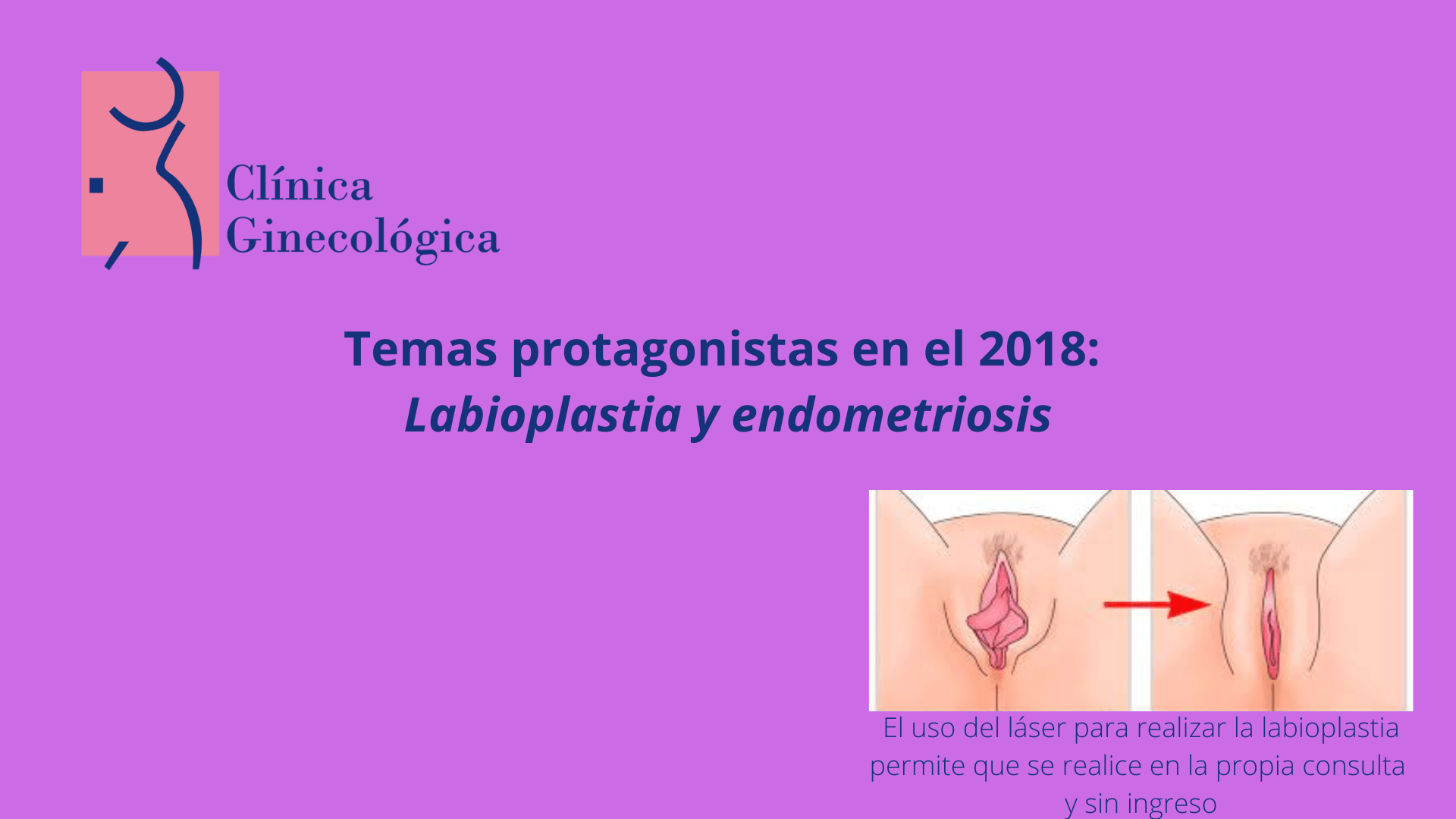 Endometriosis y labioplastia