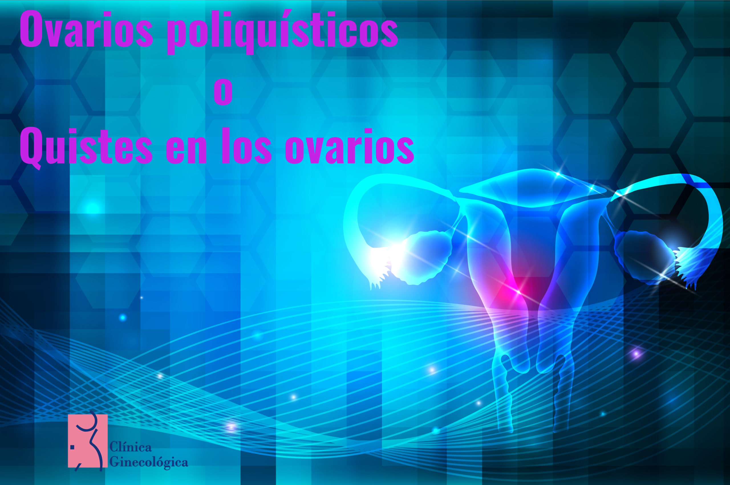 ovarios poliquísticos o quistes en los ovarios