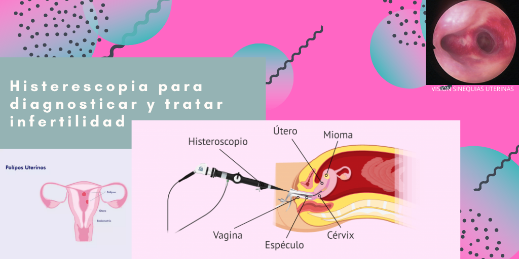 histeroscopia cirugía de la esterilidad