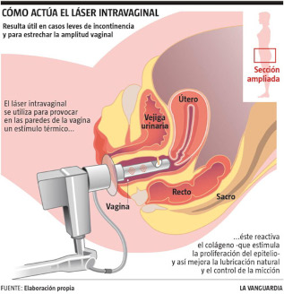 La Vanguardia - Infografía Láser Vaginal